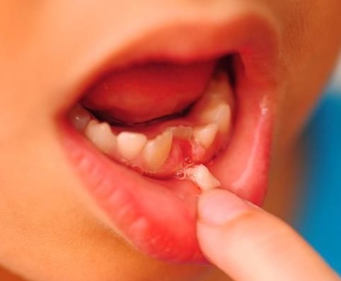 孩子几岁换牙正常？要注意些什么？